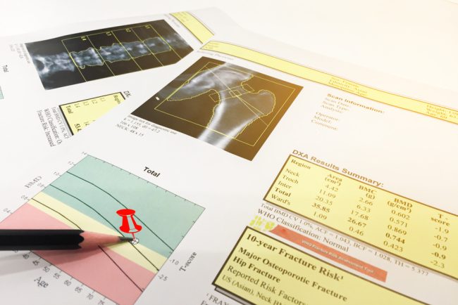 bone scan results
